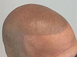 Scalp Micropigmentation